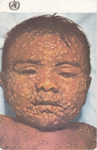 Photograph of child with smallpox used during the active disease surveillance in India.