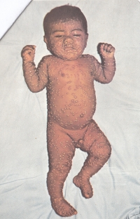 Ilustrační foto dítěte s neštovicemi využívané při aktivním vyhledávání nemoci v Indii