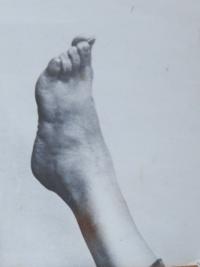 Photo of Emilie Faitová's foot. The sole bears two visible scars sustained when tortured by hot wire during interrogations 