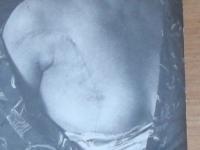 Post-surgery scar on Emilie Faitová's chest. She underwent surgery in 1950 as a result of the torture she has been subjected to during interrogations